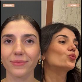 Roman Nose Rhinoplasty Result Roman Nose Rhinoplasty Result