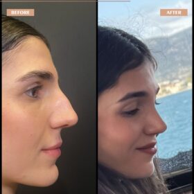 Roman Nose Rhinoplasty Result Roman Nose Rhinoplasty Result