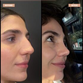 Roman Nose Rhinoplasty Result Roman Nose Rhinoplasty Result