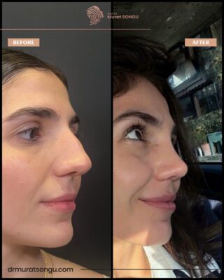 Roman Nose Rhinoplasty Result