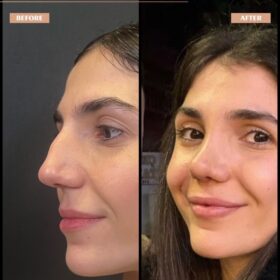 Roman Nose Rhinoplasty Result Roman Nose Rhinoplasty Result